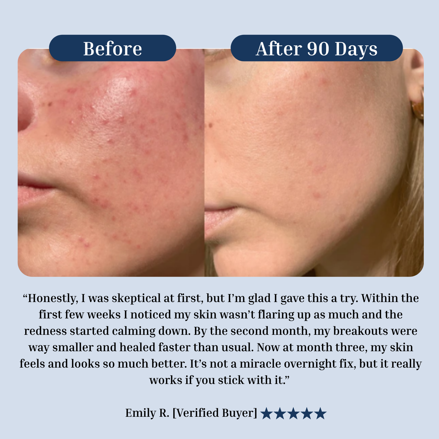 Hormonal Acne Supplement